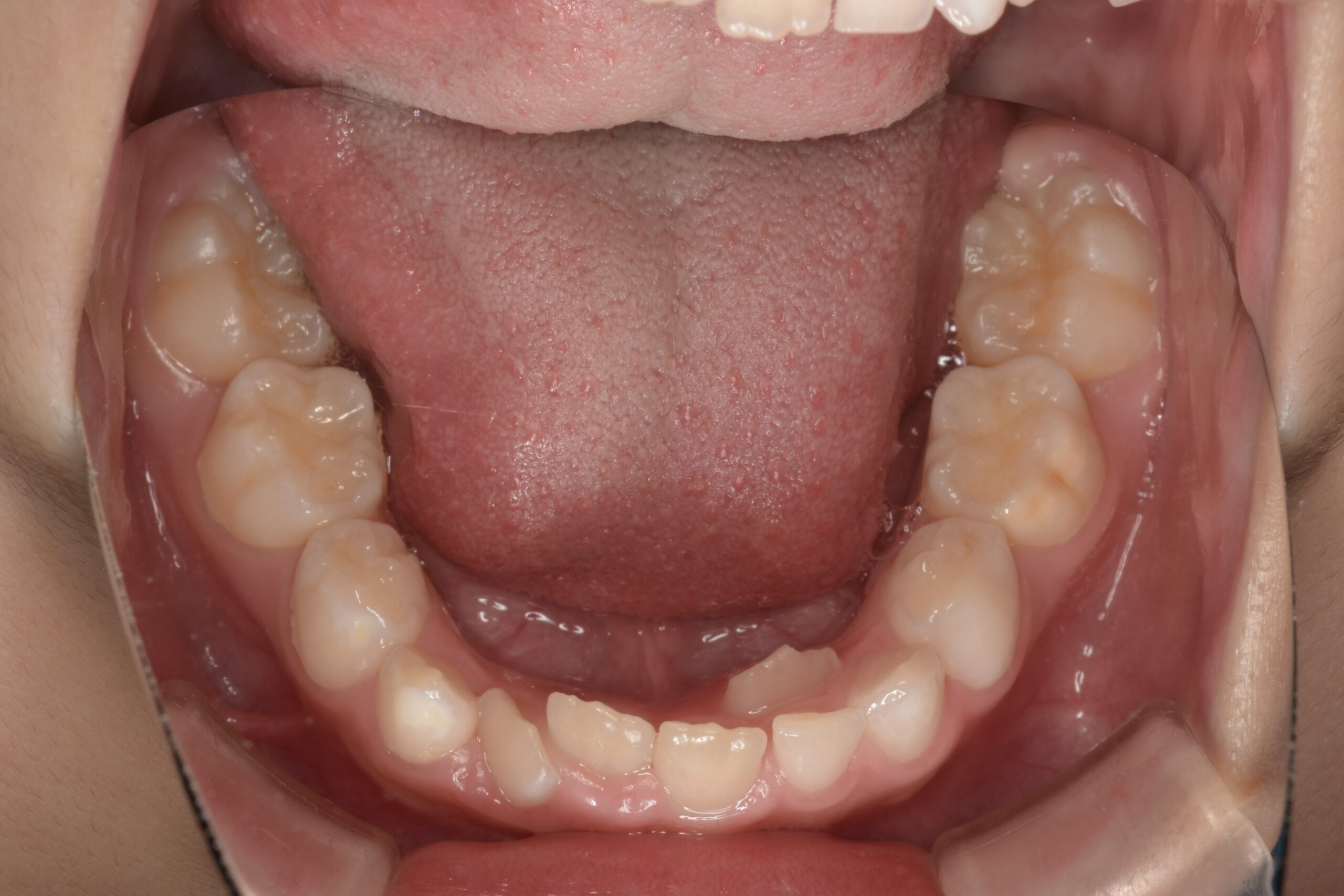 矯正の介入時期について②