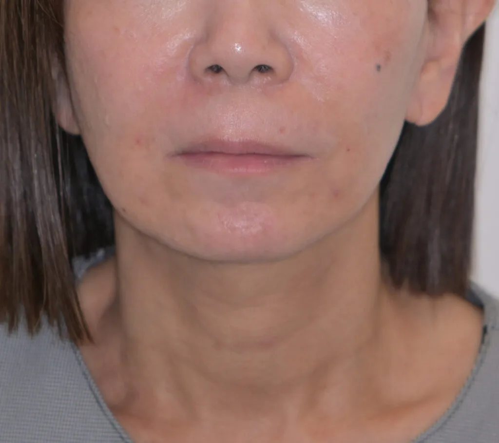 症例1　ビフォー