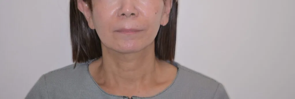 症例1　アフター